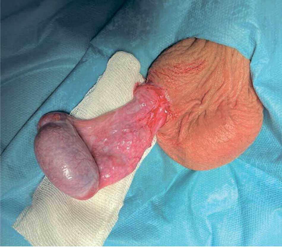 Пример гонады с нарушением фиксации и большой длиной семенного канатика после эпизода перекрута