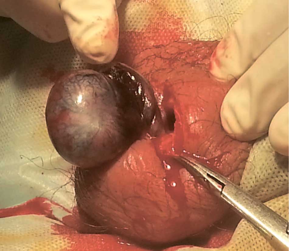 Пример перекрута яичка на 720 градусов длительностью более суток