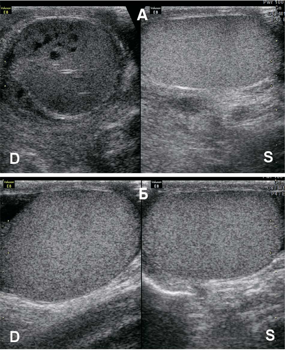 Пример перекрута яичка на 720 градусов длительностью более суток