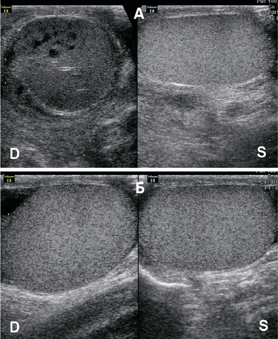 Варианты эхографической визуализации перекрученных яичек