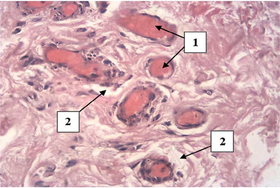 Полнокровие сосудов (1) и периваскулярный отек (2)