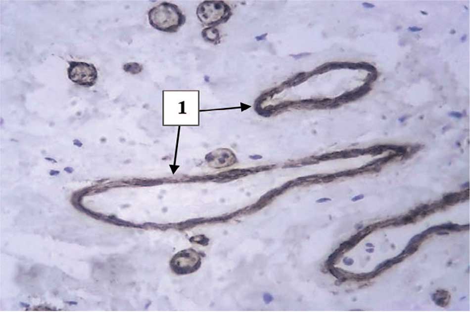 Утолщение базальных мембран кровеносных сосудов (1)