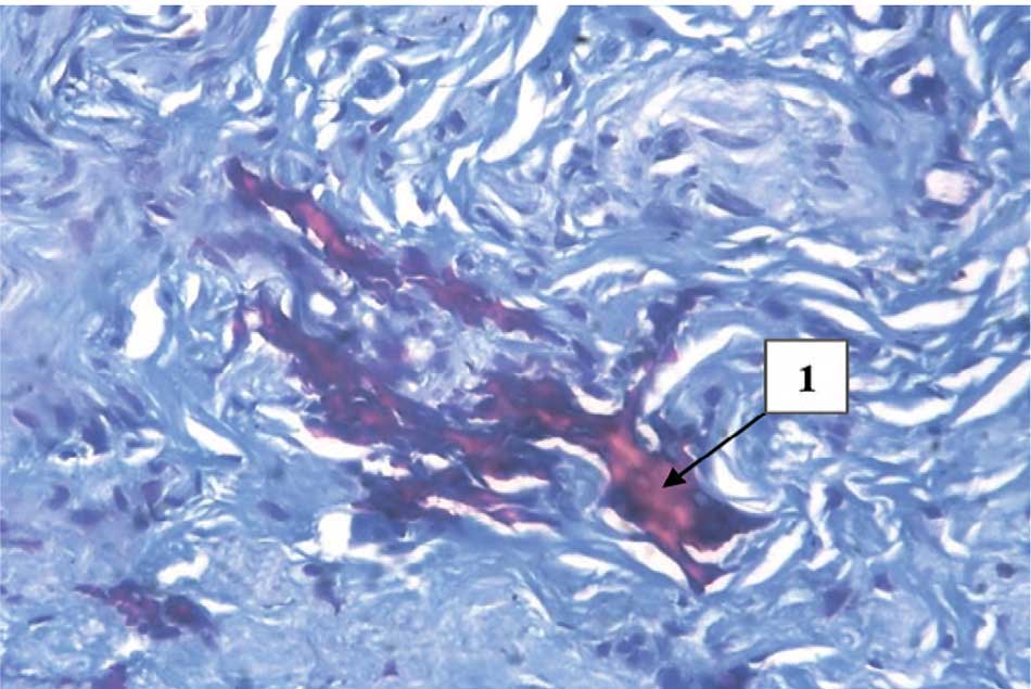 Отложение фибрина среди волокон соединительной ткани (1)