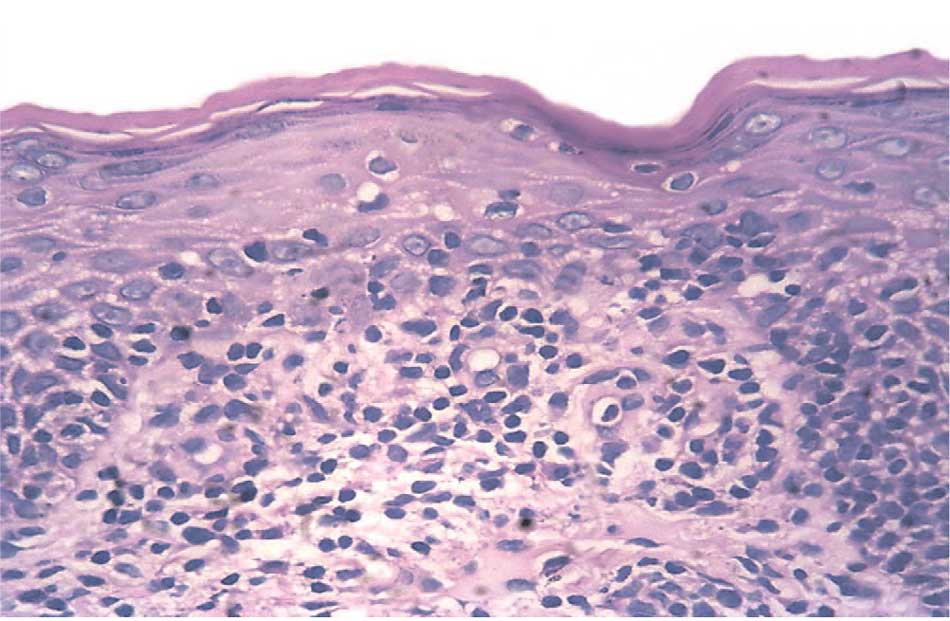 Лимфогистиоцитарная инфильтрация субэпителиальной области