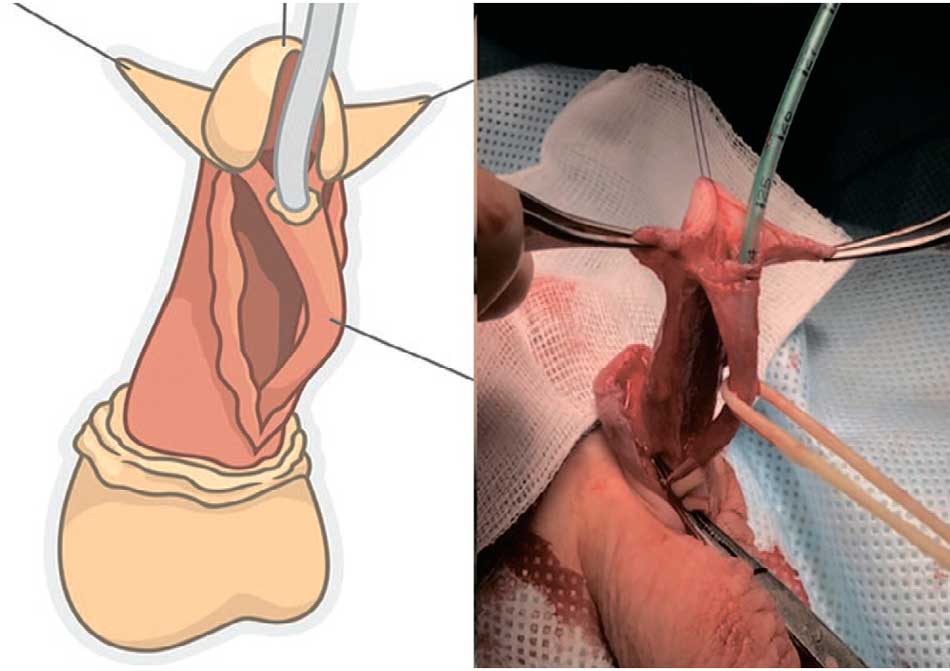 Мобилизация кожи полового члена до его основания и отделение уретры от кавернозных тел с сохранением «ножек» спонгиозного тела