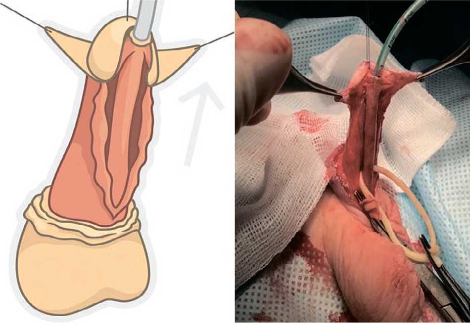 Перемещение уретры в физиологическое положение и формирование наружного отверстия уретры