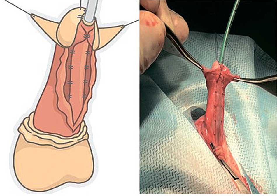 Спонгиопластика и фиксация уретры к кавернозным телам