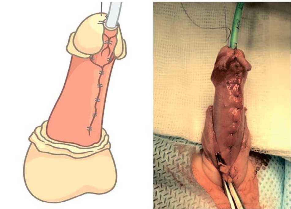 Пластика головки полового члена и укрывание уретры