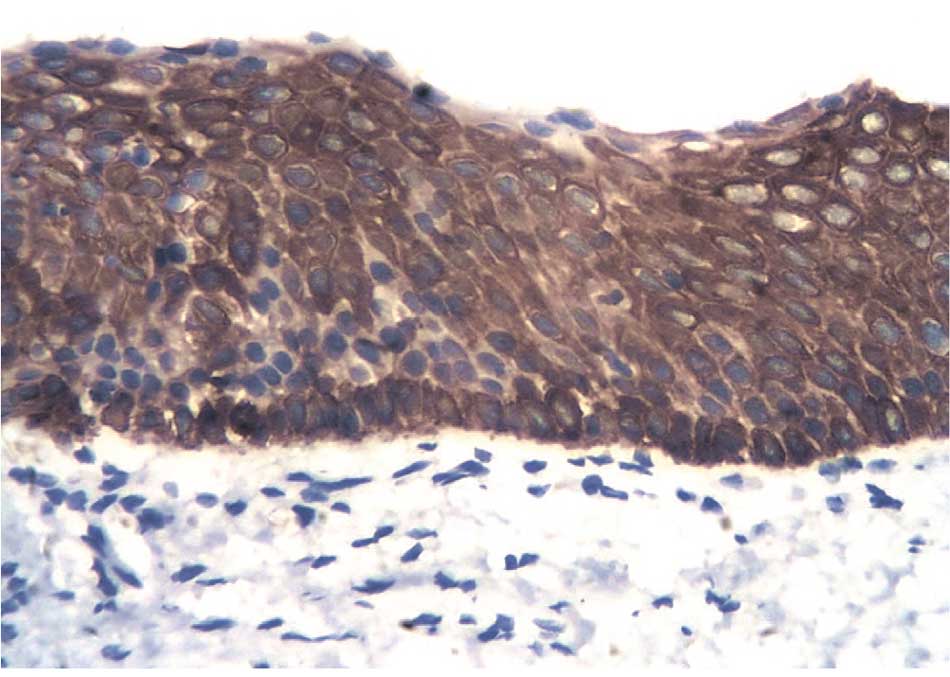 Неравномерная окраска эпителиального пласта МКАТ против панцитокератинов